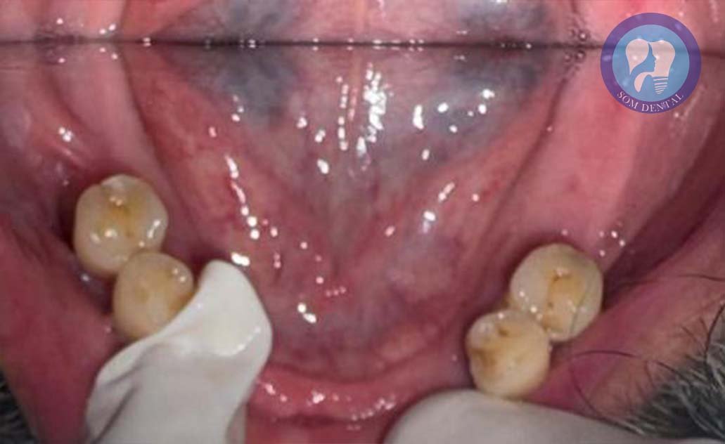 Cast Partial Dentures Gallery 1