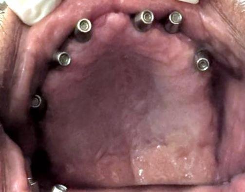 Implant Case 1