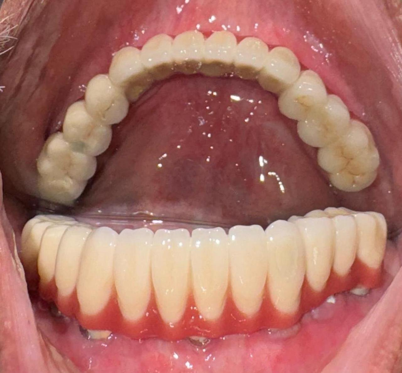 Implant Case 3