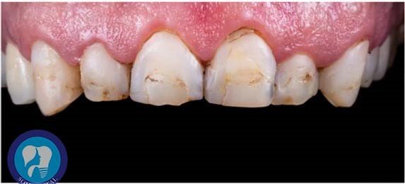 Laminates Veneers Gallery 4